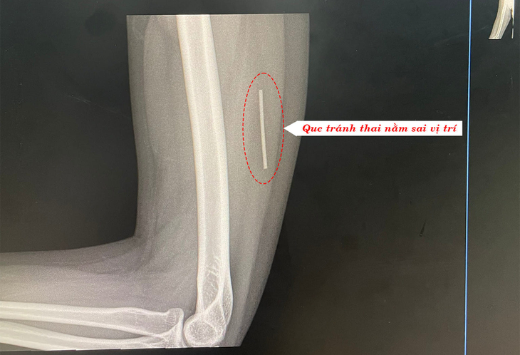 Chuyện lạ: que tránh thai ‘lạc’ trong... bắp tay - Ảnh 1. Chuyện lạ: que tránh thai ‘lạc’ trong... bắp tay - Ảnh 1.